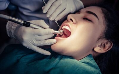 Otturazione dentale, come avviene
