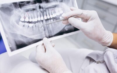 Endodonzia: tutto quello che serve sapere e le domande più frequenti sul trattamento