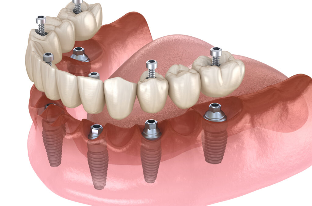 all on four e all on six implantologia dentale