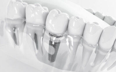 Cos’è l’implantologia dentale e quali soluzioni offre