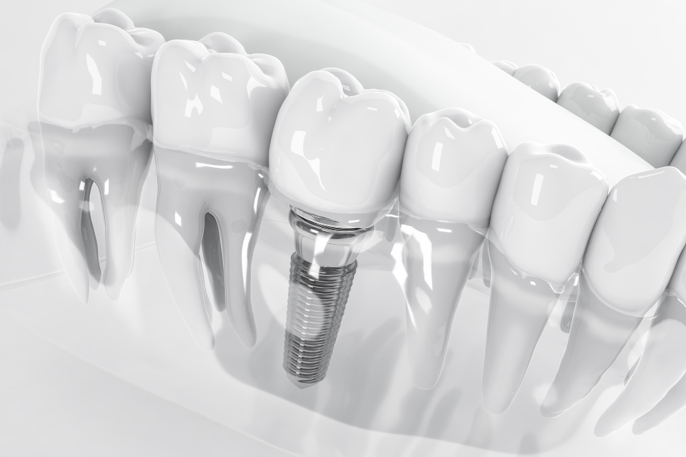Cos’è l’implantologia dentale e quali soluzioni offre