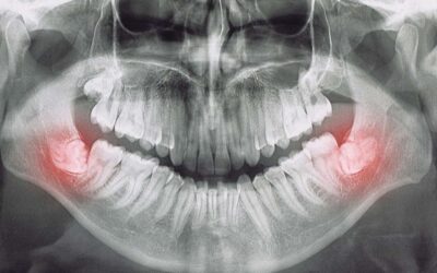Chirurgia odontostomatologica, cos’è e quando è utile