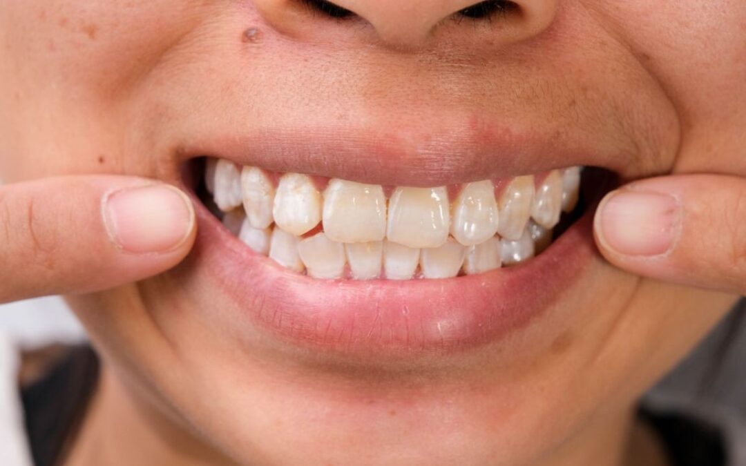 Macchie bianche sui denti: a cosa sono dovute?
